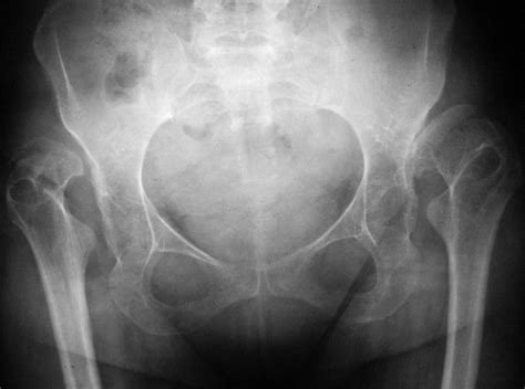 Acetabular Reconstruction In Patients With Low And High Dislocation Bone And Joint