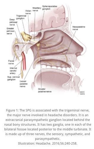 Sphenopalatine Ganglion Block