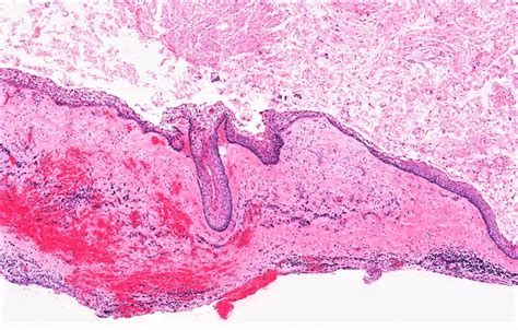 Odontogenic Keratocyst Histology