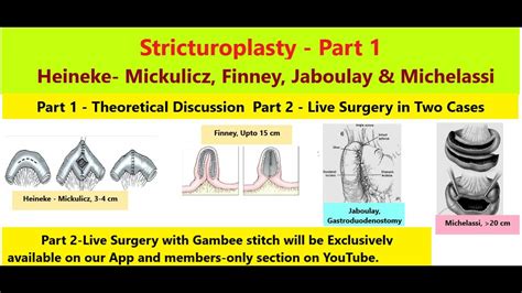 Stricturoplasty & Pyloroplasty Series Part 1/3 – Theory & Live Surgery ...