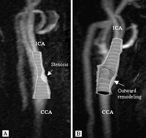 An Integrated Automated Analysis Method For Quantifying Vessel Stenosis