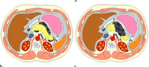 Drawings Illustrate Pancreatic Necrosis A Peripancreatic Necrosis Download Scientific