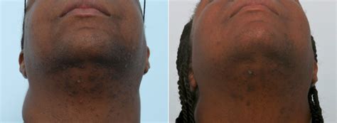 Laser Hair Removal Photos | Houston, Tx | Patient 8054