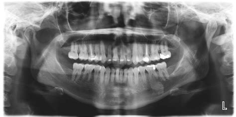 Ceroma Centro De Radiolog A Oral Y M Xilofacial Radiografia