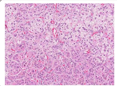 Histopathological Findings From Left Adrenal Cortical Adenoma Download High Quality