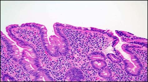 Duodenal Biopsy Showing Lamina Propria Expansion Villous Atrophy And