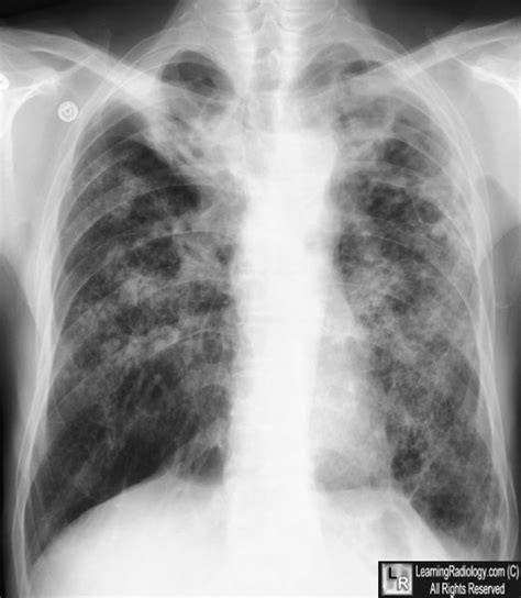 LearningRadiology - TB, tuberculosis