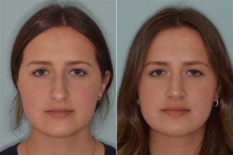 Rhinoplasty Miami Top Nose Surgeon Dr Anthony Bared