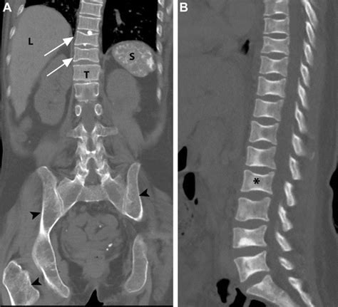 Manifestations Of Sickle Cell Disorder At Abdominal And Pelvic Imaging