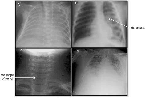 Pathogenesis Of Viral Respiratory Infection Intechopen