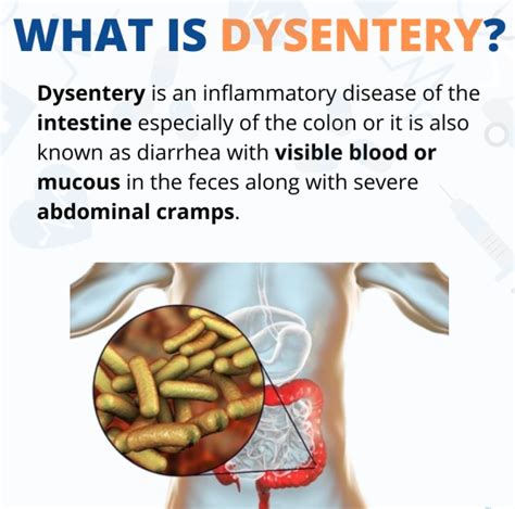 Dysentery Midwives Revision