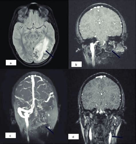 A Fluid Attenuated Inversion Recovery Flair Mri Axial Section Download Scientific Diagram