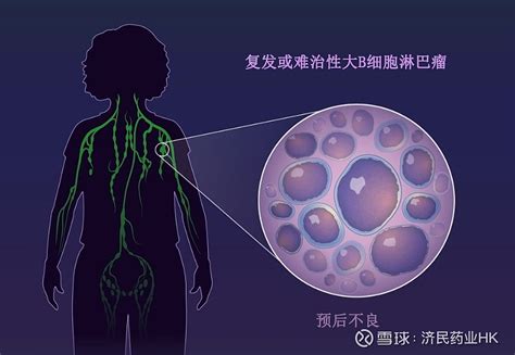 Breyanzi liso cel 在日申请用于二线治疗大B细胞淋巴瘤 百时美施贵宝 公司 Bristol Myers Squibb 于3月