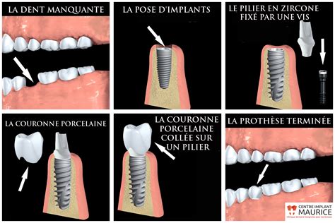 Des Dangers Des Implants Dentaires Centre Implant Maurice