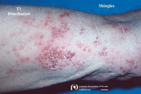 Shingles Leg Dermatome