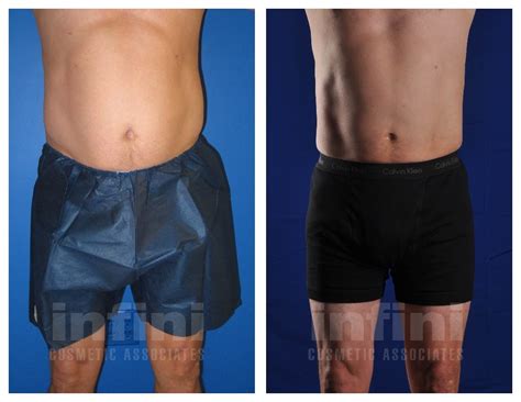 Male Liposuction Before And After Photos Stomach Phoenix Liposuction