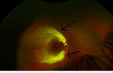 Patient S Right Eye Extensive Involvement Of Both Superotemporal And