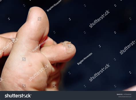 Fungus Infection On Nails Mans Footclose Stock Photo Edit Now