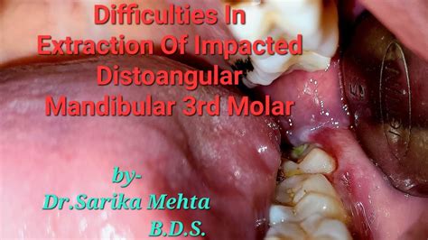 Difficulties In Extraction Of Impacted Distoangular Mandibular 3rd