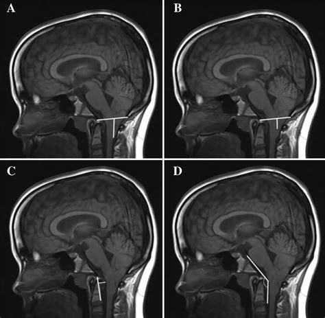 The Relationship Between Chiari 1 5 Malformation And Sleep Related