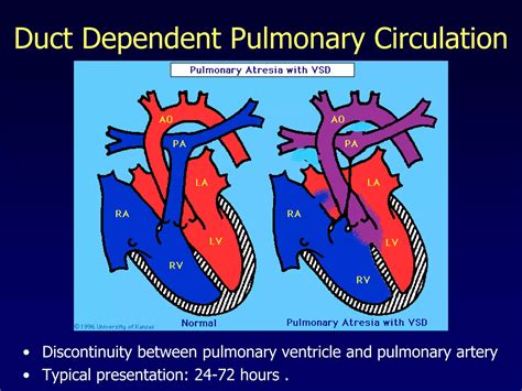 Approach To Cyanotic Congenital Heart Disease Ppt