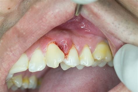 What is Periodontal (Gum) Disease? - Desert Dental Spa