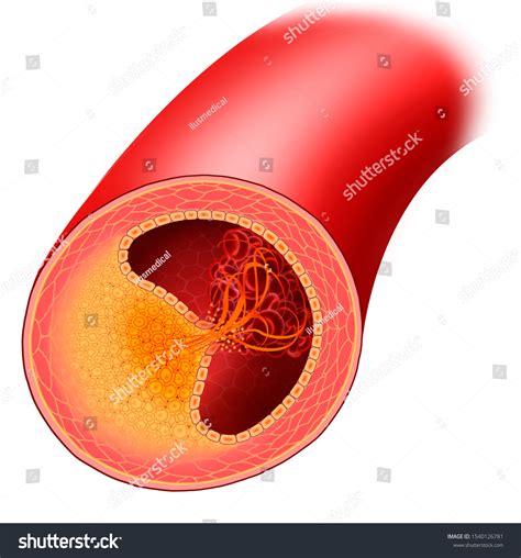 Atherosclerosis Arterial Disease Accumulation Cholesterol Fats Stock