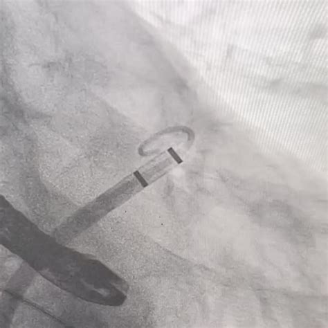 laac boston scientific cardiology