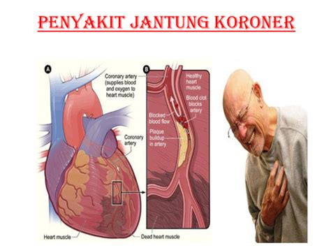 Ppt Penyakit Jantung Koroner