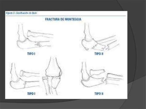 Lesión De Monteggia