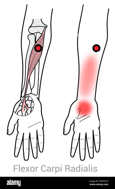 Flexor Carpi Radialis: Myofascial trigger points and associated pain locations Stock Photo - Alamy