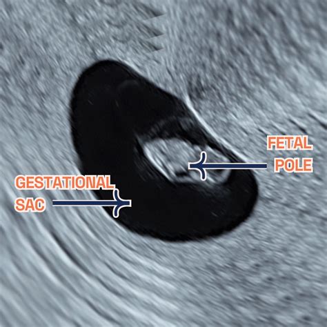 Ivf Pregnancy Monitoring London Pregnancy Clinic