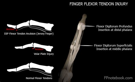 Flexor Tendon Injury At The Dip Joint