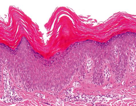 Acral Keratoderma And Sudden Death Diagnostic Histopathology