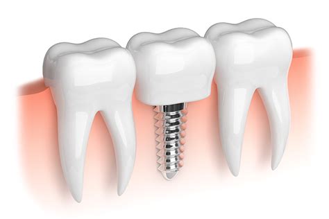 Failing Dental Implants Beverly Hills Northridge Thousand Oaks