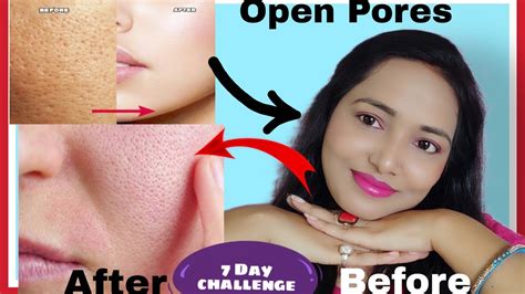 Open Pores Large Pores Clogged Pores Get Rid Of Open Pores Naturally In Just 1 Week Youtube