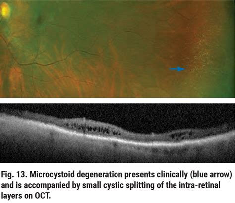 Cystoid Degeneration Retina