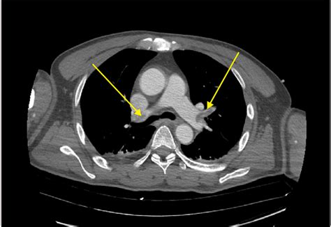 Chest spiral CT scan with a radiocontrast agent showing multiple... | Download Scientific Diagram