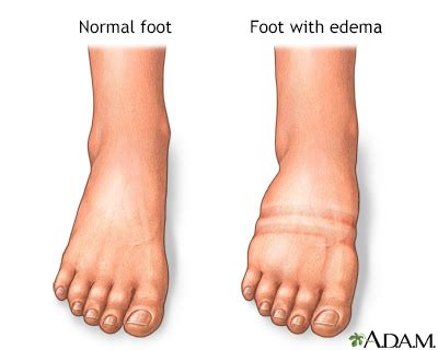 Foot Leg And Ankle Swelling Uf Health