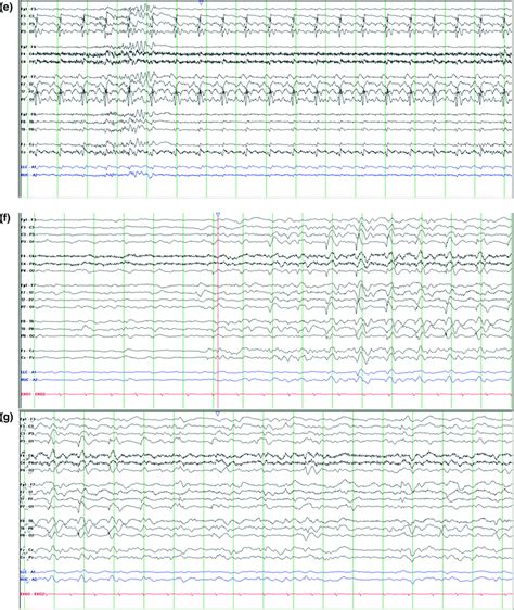 Periodic Eeg Patterns Neupsy Key