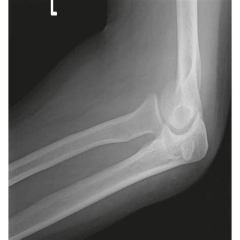 Anteroposterior And Lateral Radiographs Of The Left Elbow Joint After