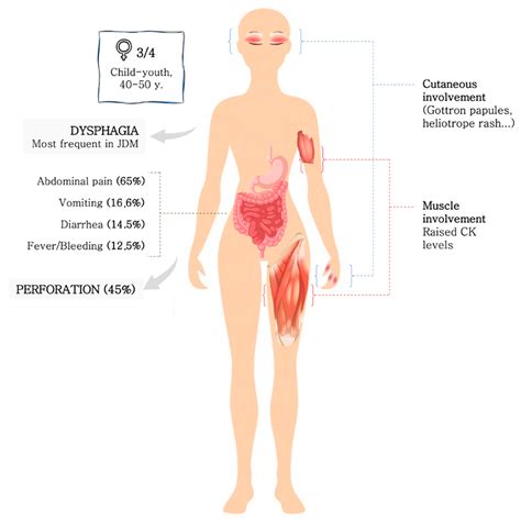 Dermatomyositis Flare Up Symptoms Draw Metro Hot Sex Picture