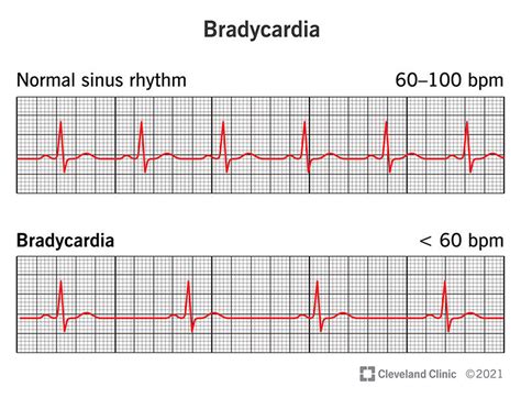 Bradycardia Symptoms Causes Treatment 56 Off