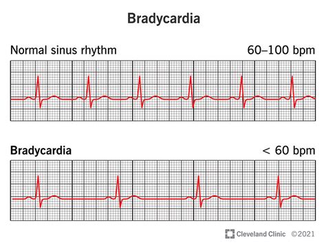 Bradycardia: Symptoms, Causes Treatment, 48% OFF