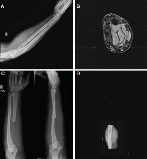 Radiographic And Magnetic Resonance Images A Preoperative Lateral