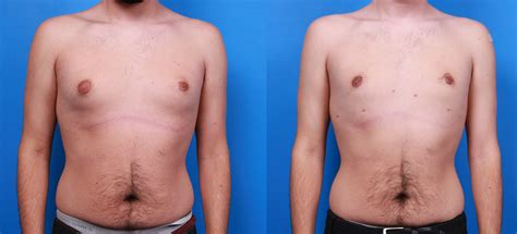 Dr Vonu Gynecomastia Before Afters Plastic Surgery Center Of