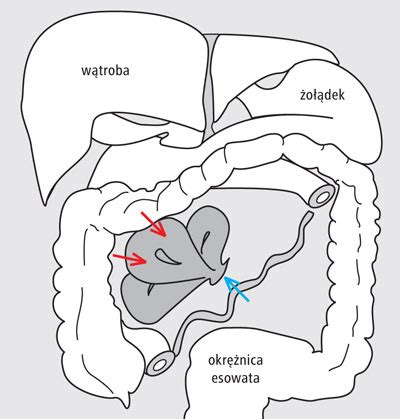 Ostre Objawy Uwi Ni Tej Wewn Trznej Przepukliny Brzusznej W
