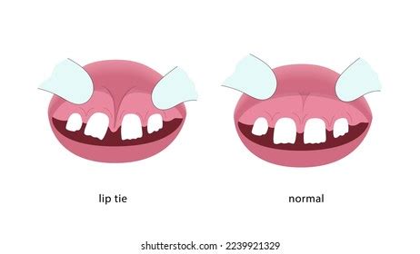 Lip Tie Illustration Before After Surgery Stock Vector (Royalty Free) 2239921329 | Shutterstock