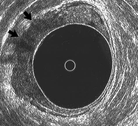 Comparison Of Transrectal Sonography And Double Contrast Mr Imaging