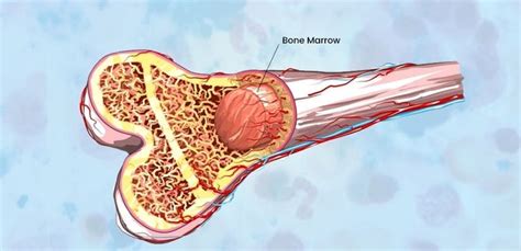 The Different Stages Of A Bone Marrow Transplant